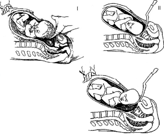 Извлечение головки плода при кесаревом сечении в нижнем маточном сегменте: I - извлечение головки плода по руке; II - извлечение головки плода по ложке акушерских щипцов.