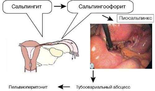 Распространение инфекционного процесса